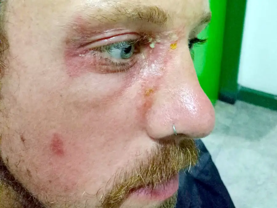 travel medical insurance emergency - Brian had a nasty skin reaction around his eye after simply coming into contact with a Rove Beetle in Bali